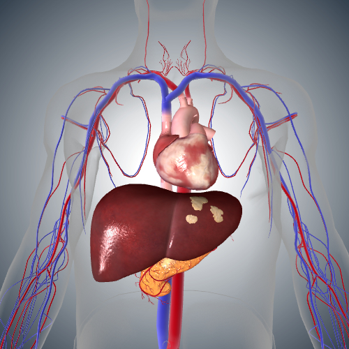 Pancreatic Cancer: Stage IV