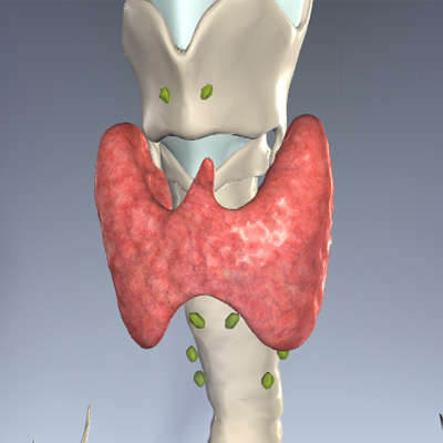 Thyroid Cancer Stage N1a