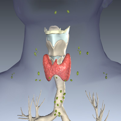 Thyroid Cancer Stage N1b