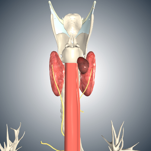 Thyroid Cancer Stage T4a - Cricoid Cartilage Involvement