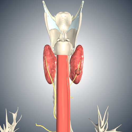 Thyroid Cancer Stage T4a - Recurrent Laryngeal Involvement