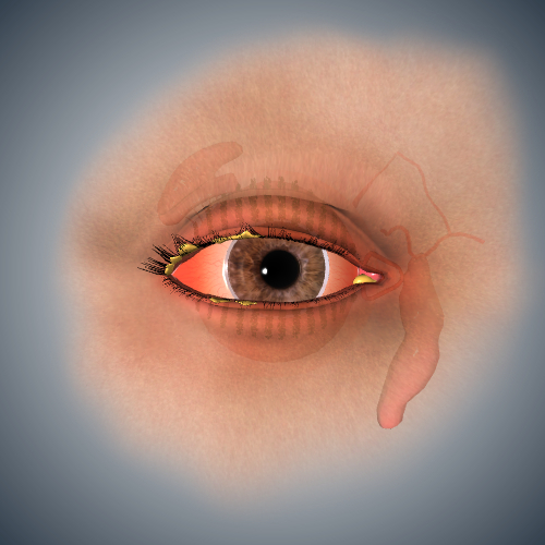 Conjunctivitis