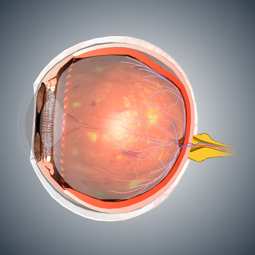 Diabetic Eye Cross Section