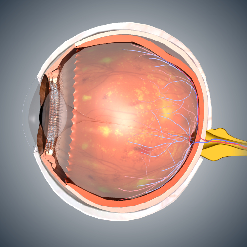 Diabetic Retinopathy