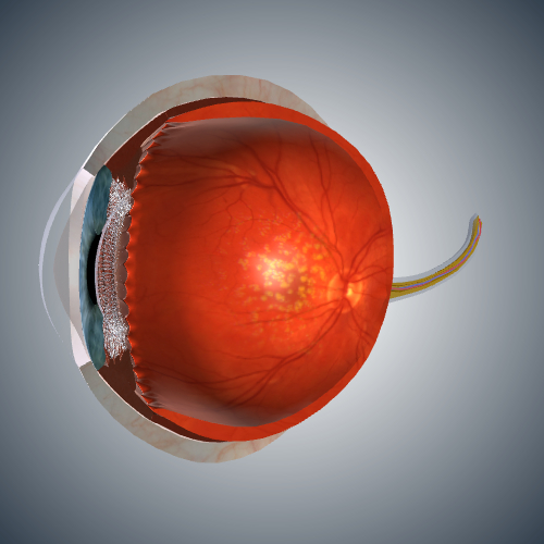 Dry Macular Degeneration