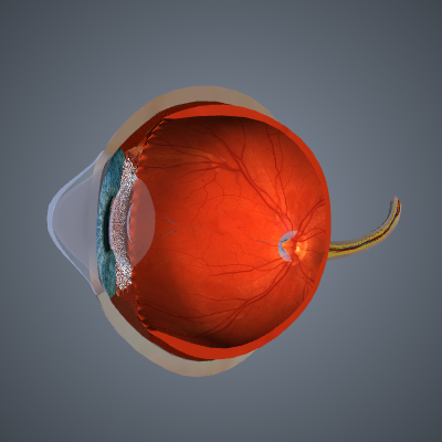 Keratoconus