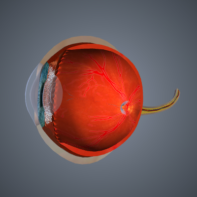 Ocular Hypertension