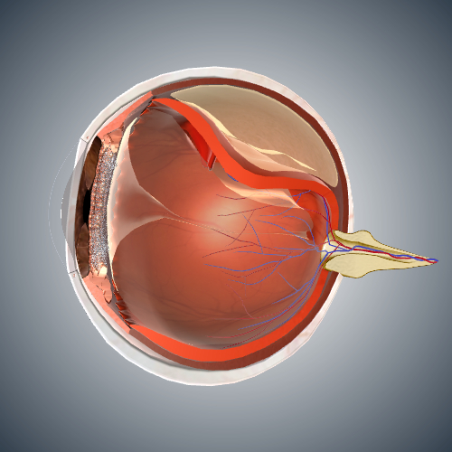 Retinal Detachment