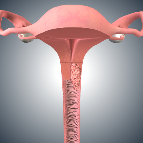 Cervical Cancer: Stage II