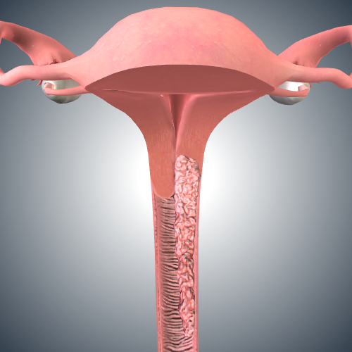 Cervical Cancer: Stage III