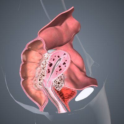 Endometriosis - Advanced