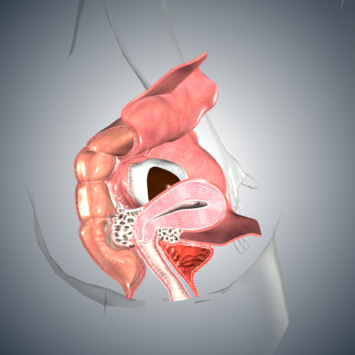 Endometriosis