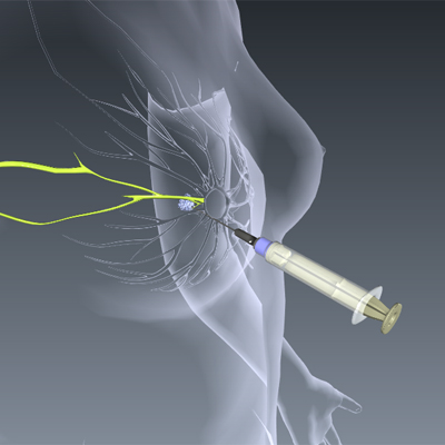 Sentinel Node Biopsy