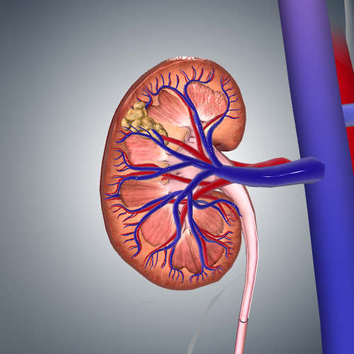 Kidney Cancer: Stage I