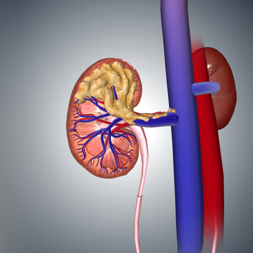 Kidney Cancer: Stage III