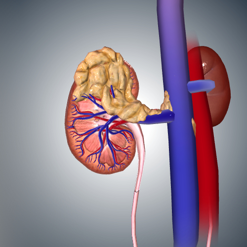 Kidney Cancer: Stage IV