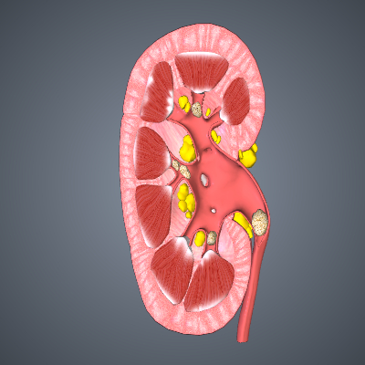 Kidney Stones