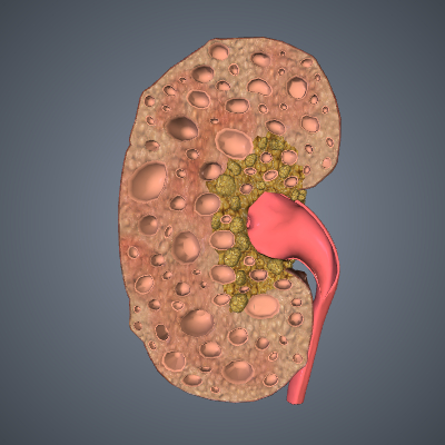 Polycystic Kidney Disease