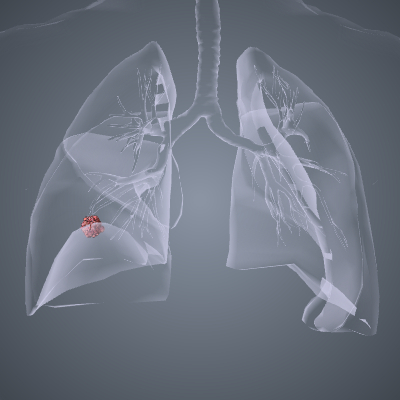 Lung Cancer Stage 1