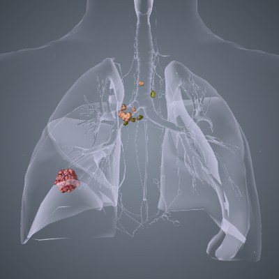 Lung Cancer Stage 3