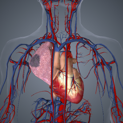 Pulmonary Embolism