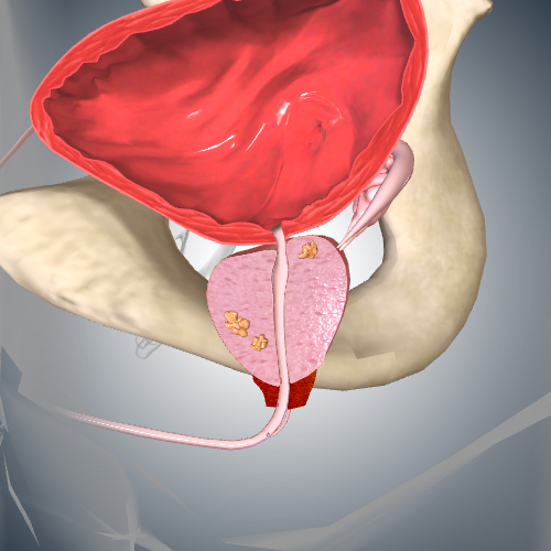 Prostate Cancer: Stage II