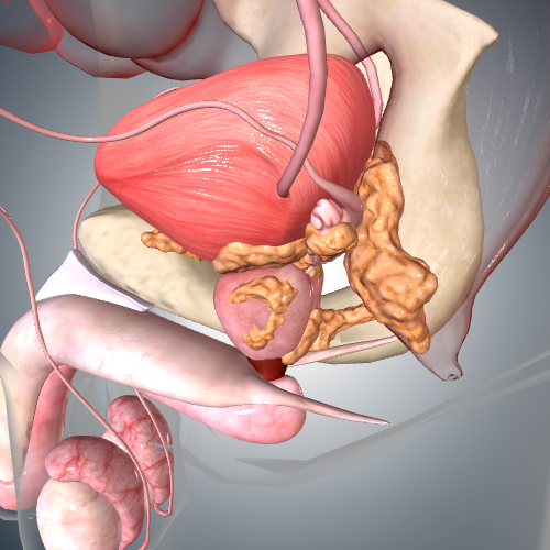 Prostate Cancer: Stage IV