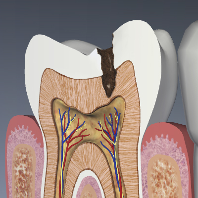 Cavity of the tooth