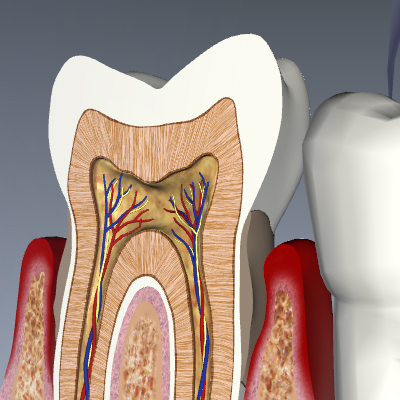 Periodontitis