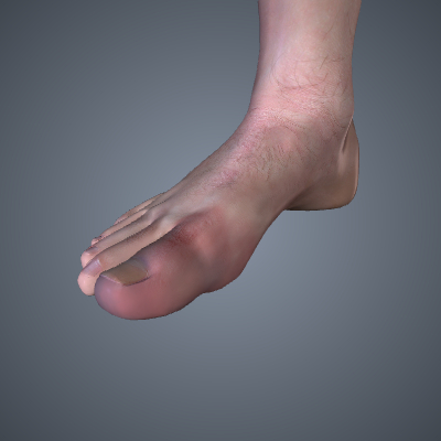 Acute Osteomyelitis of the Foot