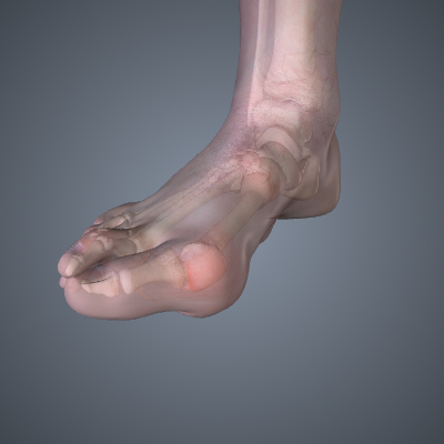 Bunions and Overlapping Toes