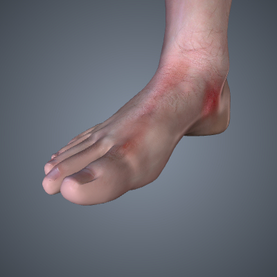 Cellulitis and Lymphangitis of the Foot