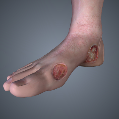Deep Skin and Soft Tissue Infections of the Foot