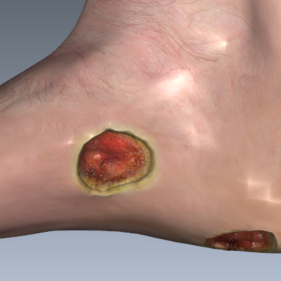 Foot Ulcers