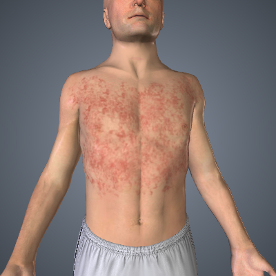 Maculopapular Rash