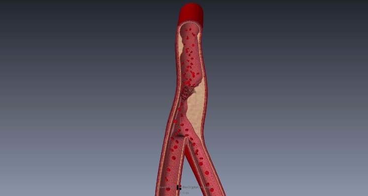 aterosclerosis